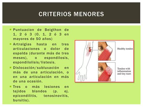 Síndrome De Hiperlaxitud Articular Ppt