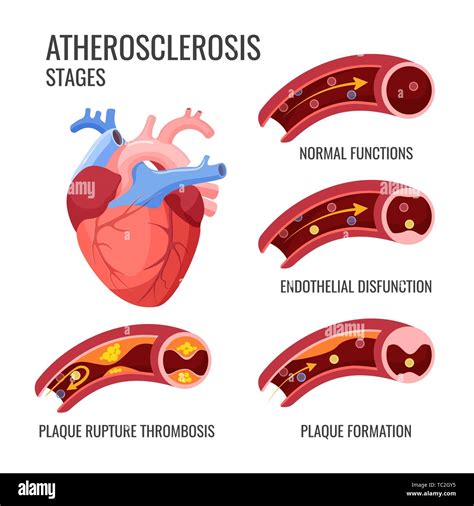 Atherosclerosis Stages Normal Functions Endothelia Disfunction