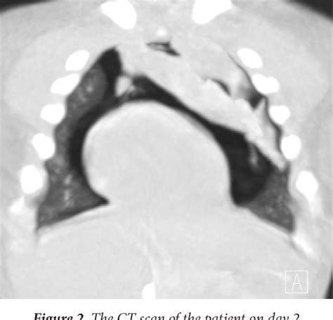 Figure 2 From A Rare Cause Of Respiratory Distress In A Newborn Pneumomediastinum Semantic