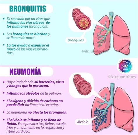 Notas de Enfermería Diferencia entre bronquitis y neumonía