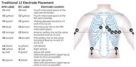 Diagnostic Ecg Lead Placement Clinical View