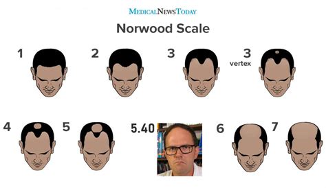 Bimmy and the Norwood Baldness Scale : r/TheCinemassacreTruth