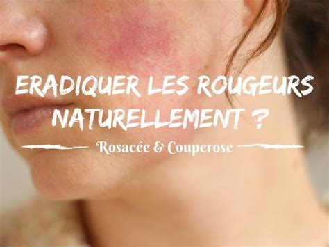 Comment traiter naturellement les rougeurs rosacée couperose en