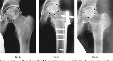 Pdf Osteonecrosis Of The Femoral Head Simple Varus Intertrochanteric