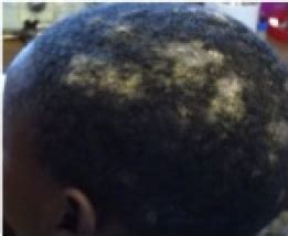 Hair loss, marked crusting and Kerion formation. Note: Kerion of the ...