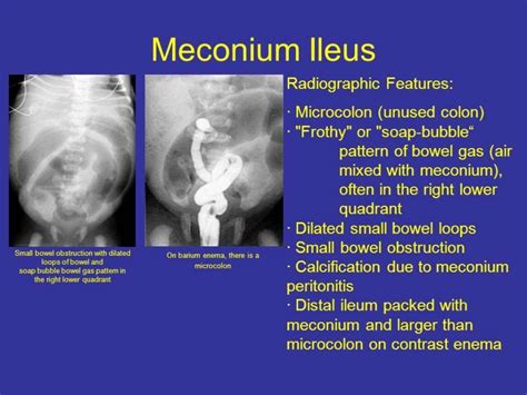 Meconium ileus Simple