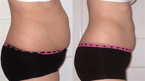 Strawberry Inch Loss Non Surgical Laser Lipo Fat Reduction