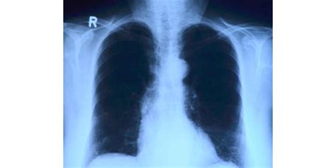 Radiografía De Tórax Técnica