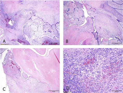 Phyllodes Tumor A Stromal Overgrowth B Heterogeneity With