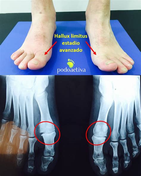 Hallux Limitus Podoactiva L Deres En Podolog A