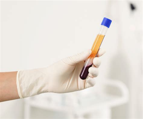 The Gael Center Unlocking The Potential Of Platelet Rich Plasma Prp