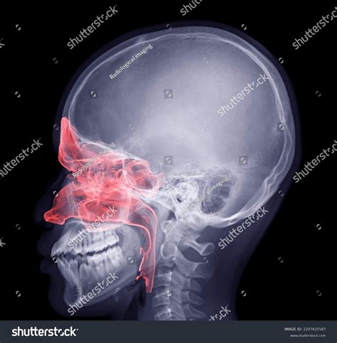 Skull Xray Image Fusion Paranasal Sinuses Stock Illustration 2207625587 | Shutterstock