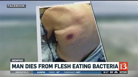 Memphis Man Dies After Contracting Flesh Eating Bacteria In Destin