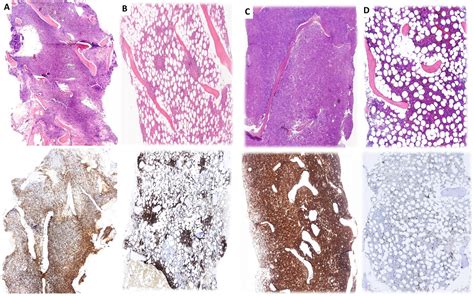 Bone Marrow Core Biopsy