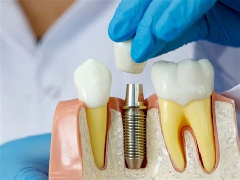 Complete Guide How To Care For Your Dental Implants Tips For