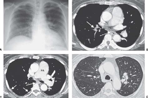 Pulmonary Vasculature Disease Radiology Key