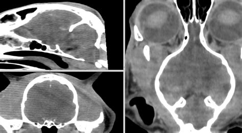 Ct Polyploid Hyperplasia Of The Frontal Sinus And Nasal Conceal