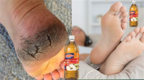 Soaking Feet In Apple Cider Vinegar What Happens Youtube