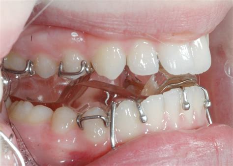 Orthodontic Corner Design And Management Of Twin Blocks