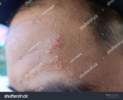 Picture Blisters On Face Due Shingles Foto Stock 1786423664 Shutterstock