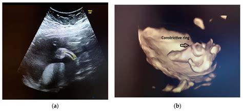 Diagnostics Free Full Text Amniotic Band Syndrome—prenatal Diagnosis