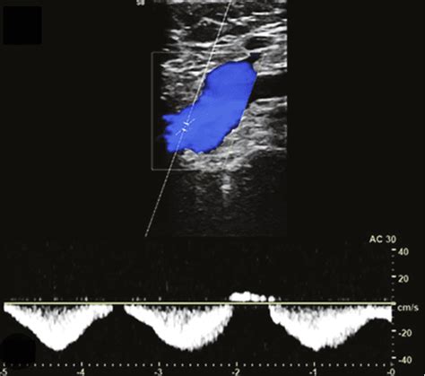 Deep Vein Thrombosis DVT Review Of DVT Assessment Can We Assess