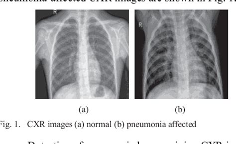 Deep Learning for Pneumonia Diagnosis Using CXR Images | Semantic Scholar