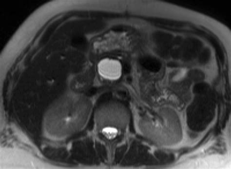 MR Imaging Of Cystic Lesions Of The Pancreas RadioGraphics