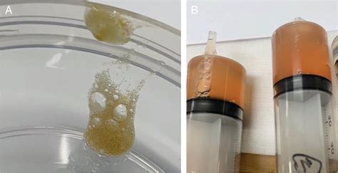 (A) Orange‐coloured sputum is observed. (B) Orange‐coloured... | Download Scientific Diagram