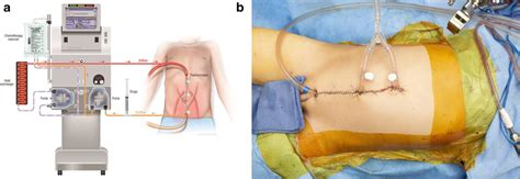 Hyperthermic intraperitoneal chemotherapy (HIPEC). a Diagram shows the ...