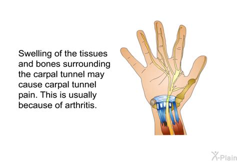 Carpal Tunnel Prevention