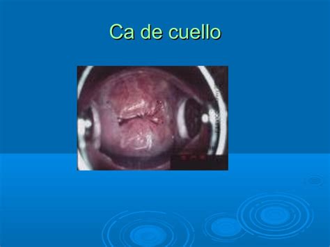 Cervicitis Introduccion Y Descripcion