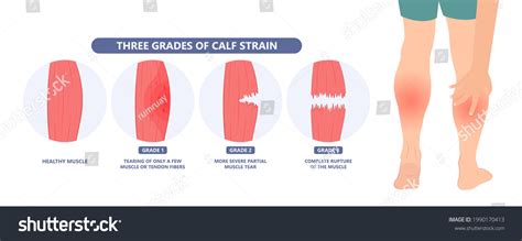 1,711 Muscle Tear Images, Stock Photos & Vectors | Shutterstock