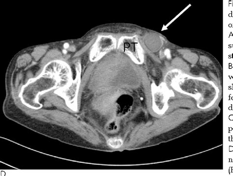 Figure 1 From Differentiation Of A Femoral Hernia From An Inguinal