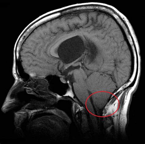 chiari ii radiology  chuck miranda blog