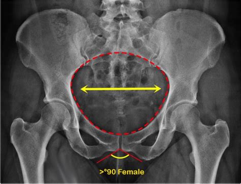 Pediatric Pelvis Trauma Radiographic Evaluation - Pediatrics - Orthobullets