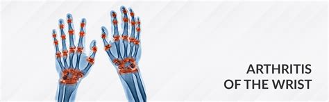 Arthritis Of The Wrist Dr Saurabh Aggarwal