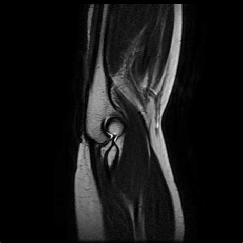 Cubital Tunnel Syndrome Image