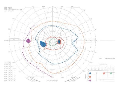 Presentation Of Ischemic Hemorrhagic Retinal Vasculitis After Cataract