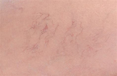 5 Things You Need To Know About Spider Veins Grand Junction Vein Center