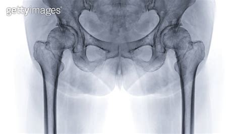 An X Ray Reveals Both Hip Joints In Normal Study