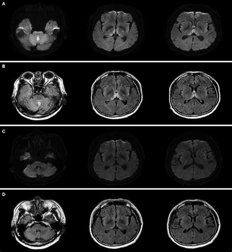 Figure 1 From Wernicke Encephalopathy Associated With Acute Wet