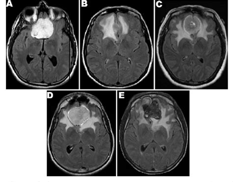 Pdf Endoscope Assisted Endonasal Versus Supraorbital Keyhole