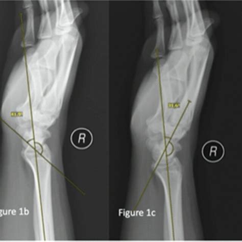 A Lateral Scapholunate Angle B Lateral Radio Scaphoid Angle C Lateral