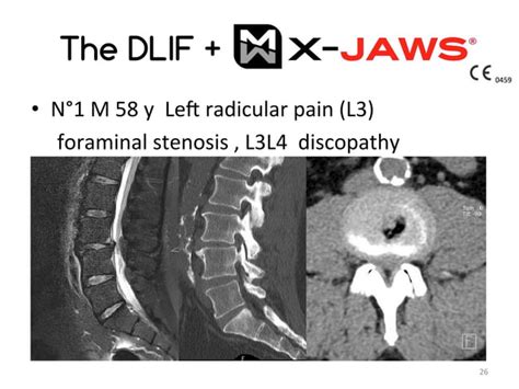 Lateral Lumbar Interbody Fusion Dlif Xlif With Lateral Fixation In