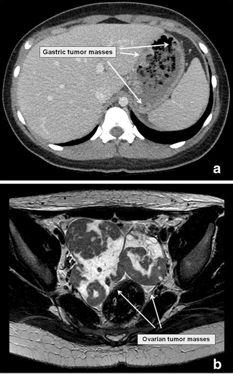 Abdominal Tumor CT Scan