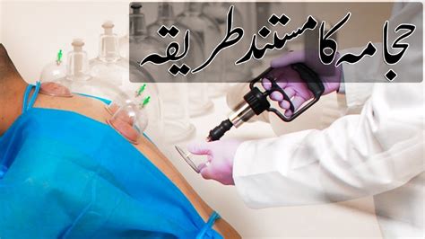 Hijama Wet Cupping Procedure Benefits Of Hijama By Dr Sohail Zafar