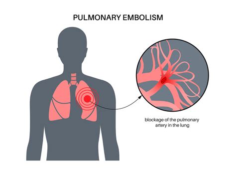 3 Symptoms Of Pulmonary Embolism Beaumont Emergency Hospital