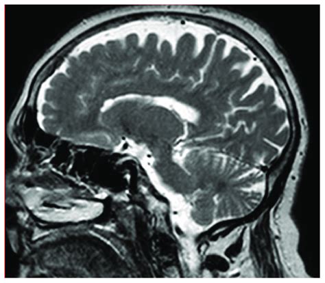 T2-weighted MR sagittal brain image shows mild whole-brain atrophy and ...