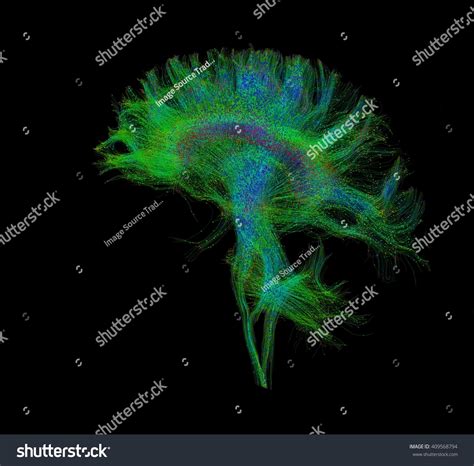 Diffusion Mri Referred Diffusion Tensor Imaging Stock Illustration